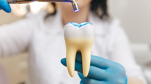Dentist demonstrating dental bonding on large model tooth