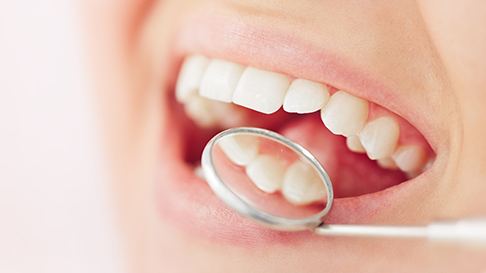 Nose-to-chin closeup of flawless teeth reflected in dental mirror