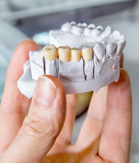 Dentist in Washington NJ showing a traditional dental bridge on a plaster model