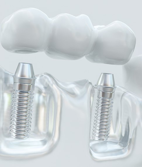 An illustration of an implant bridge 