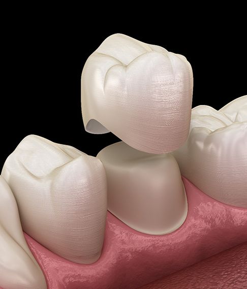 A dental crown being placed on a tooth