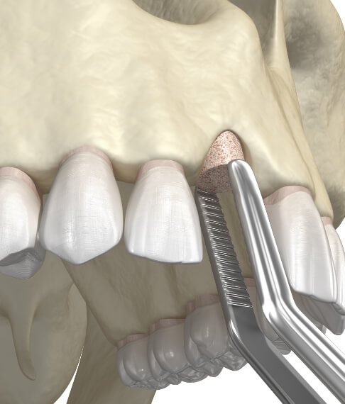 Animated smile during bone grafting procedure