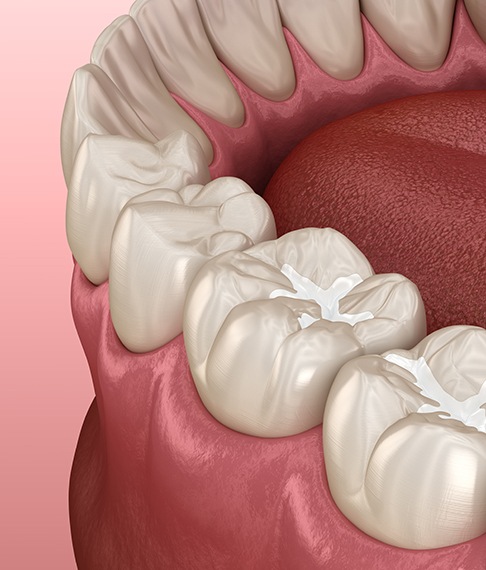 Tooth-colored fillings