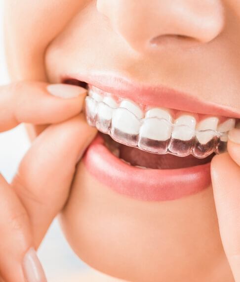 Closeup of patient placing an Invisalign tray