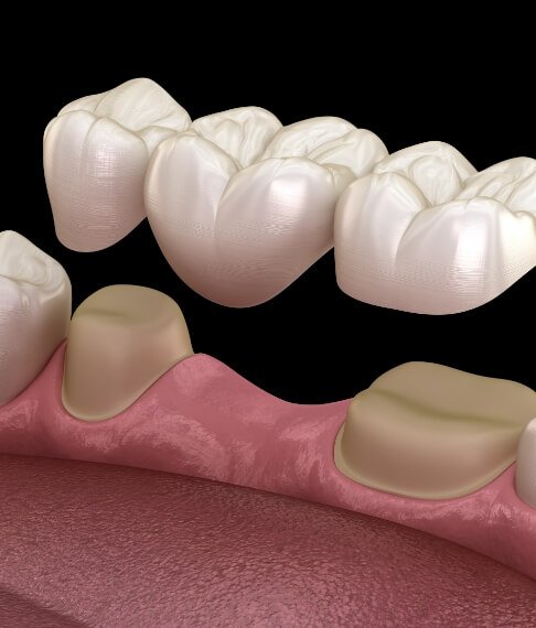 Animated smile during dental bridge placement