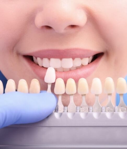 Patient's smile compared with tooth colored filling shades