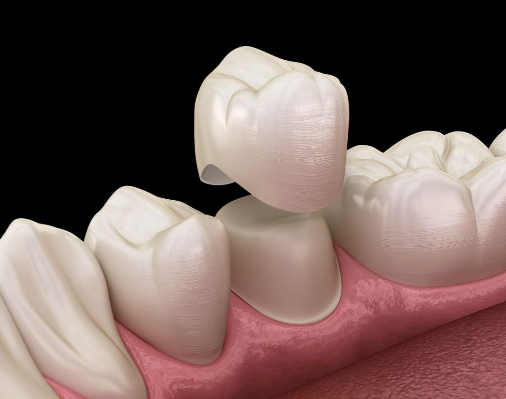 A computer-generated image of a dental crown being placed on a tooth.