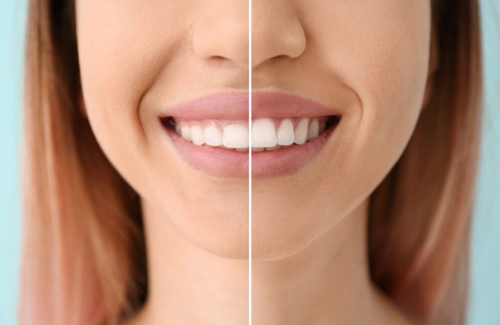 A woman before and after gum recontouring