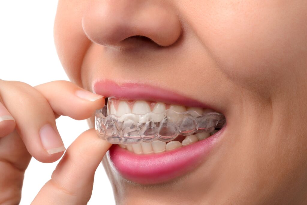 Nose-to-chin view of woman putting Invisalign over upper arch