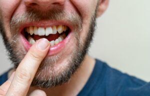 Man with open mouth pointing to broken front tooth.
